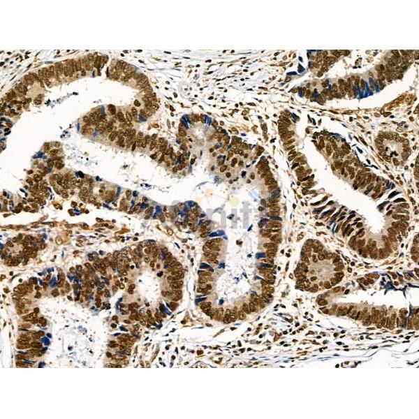 Phospho-TLK1 (Ser741) Antibody - AF8029 at 1/100 staining Human colorectal cancer by IHC-P.