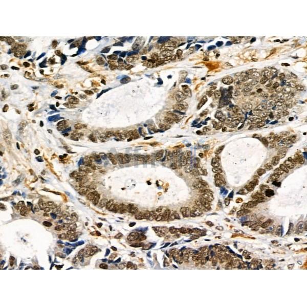 Phospho-TLK1 (Ser741) Antibody - AF8029 at 1/100 staining Human colorectal cancer by IHC-P.