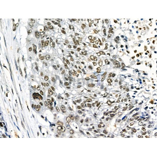 Phospho-TLK1 (Ser741) Antibody - AF8029 at 1/100 staining Human esophageal cancer by IHC-P.