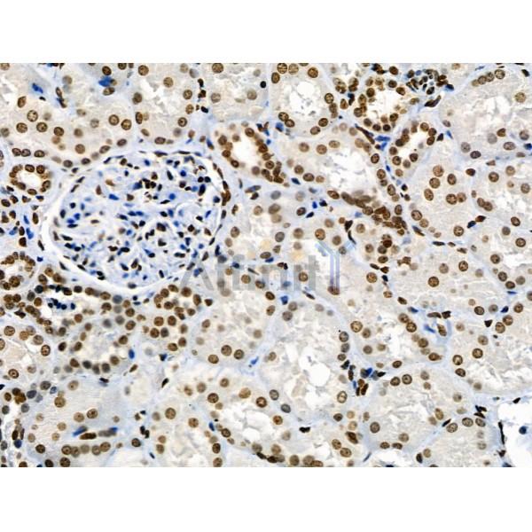Phospho-CAMKK1/2 (Ser458/Ser495) Antibody - AF8136 at 1/100 staining Human kidney cancer and adjacent normal tissues by IHC-P.