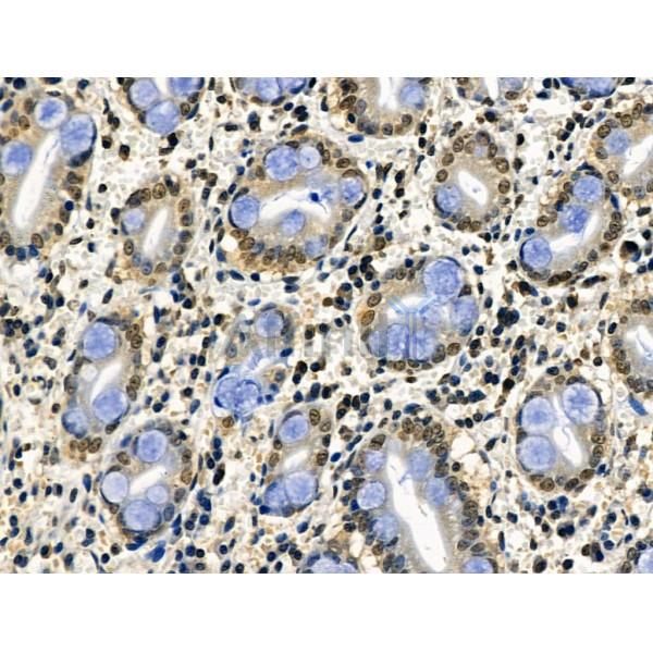 Phospho-CAMKK1/2 (Ser458/Ser495) Antibody - AF8136 at 1/100 staining Human gastric cancer and adjacent normal tissues by IHC-P.