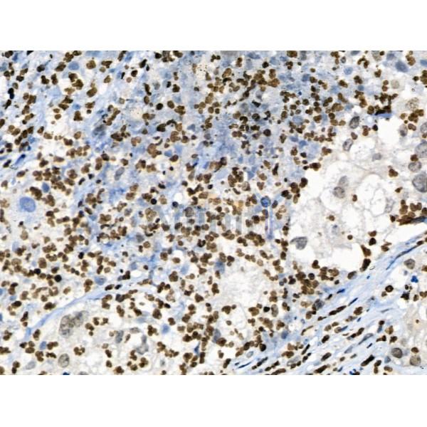 Phospho-CAMKK1/2 (Ser458/Ser495) Antibody - AF8136 at 1/100 staining Human ovarian cancer by IHC-P.