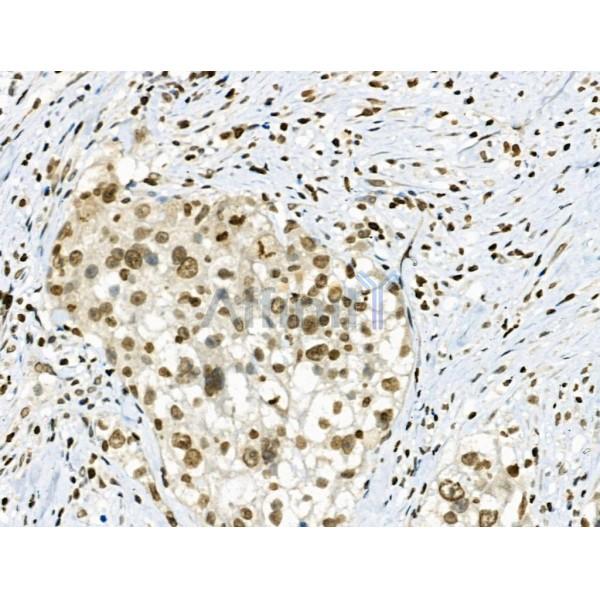 Phospho-CAMKK1/2 (Ser458/Ser495) Antibody - AF8136 at 1/100 staining Human ovarian cancer by IHC-P.