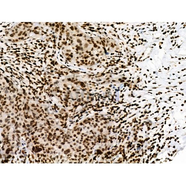 Phospho-RXR alpha (Ser260) Antibody - AF8214 at 1/100 staining Human ovarian cancer by IHC-P.