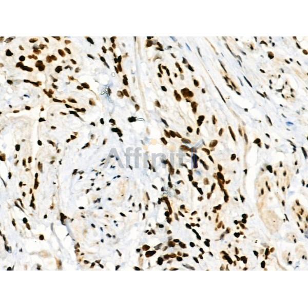 Phospho-RXR alpha (Ser260) Antibody - AF8214 at 1/100 staining Human ovarian cancer by IHC-P.