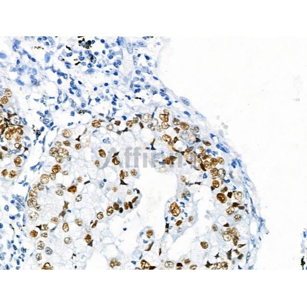 Phospho-p53 (Ser392) Antibody - AF8295 at 1/100 staining Human lung cancer by IHC-P.