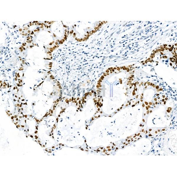 Phospho-p53 (Ser392) Antibody - AF8295 at 1/100 staining Human lung cancer by IHC-P.