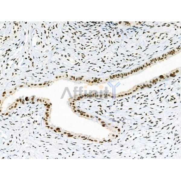 Phospho-p53 (Ser392) Antibody - AF8295 at 1/100 staining Human ovarian cancer and adjacent normal tissues by IHC-P.
