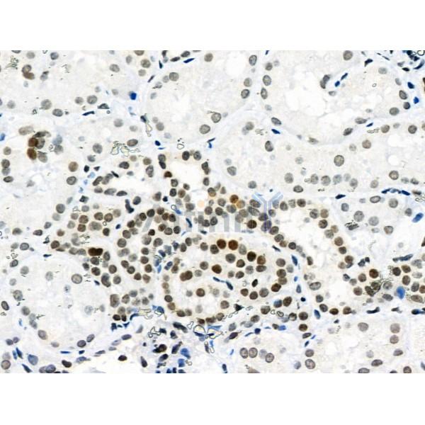 Phospho-p53 (Ser392) Antibody - AF8295 at 1/100 staining Human kidney cancer and adjacent normal tissues by IHC-P.