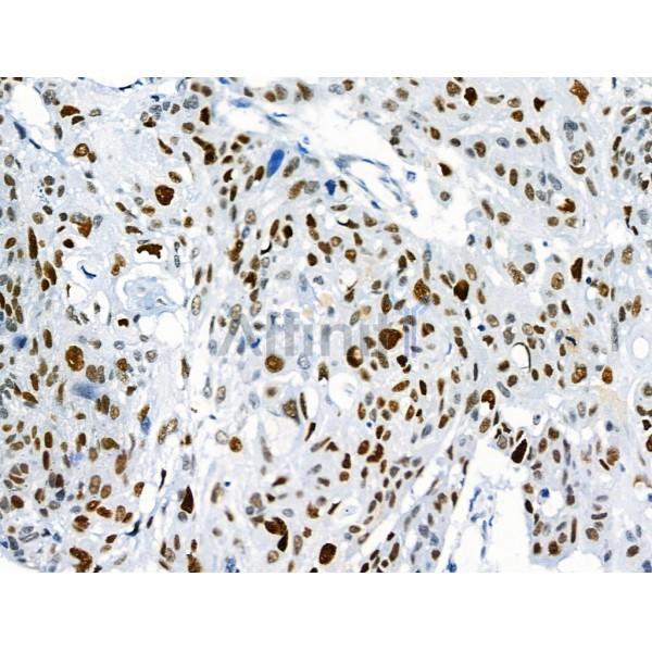 Phospho-p53 (Ser392) Antibody - AF8295 at 1/100 staining Human esophageal cancer by IHC-P.