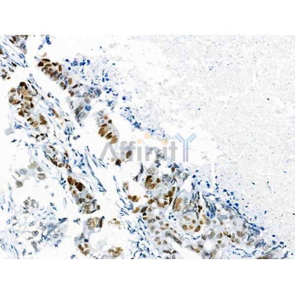 Phospho-p53 (Ser392) Antibody - AF8295 at 1/100 staining Human gastric cancer by IHC-P.