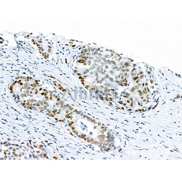 Phospho-p53 (Ser392) Antibody - AF8295 at 1/100 staining Human gastric cancer by IHC-P.