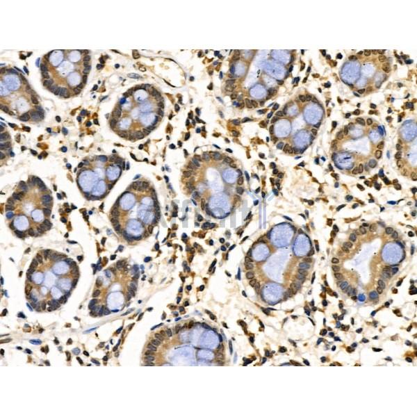 CDK8 Antibody - DF3186 at 1/100 staining Human gastric cancer and adjacent normal tissues by IHC-P.
