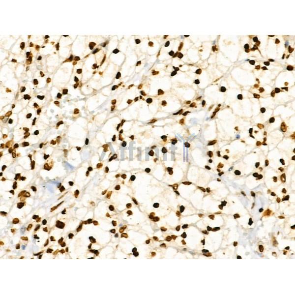 CDK8 Antibody - DF3186 at 1/100 staining Human kidney cancer by IHC-P.