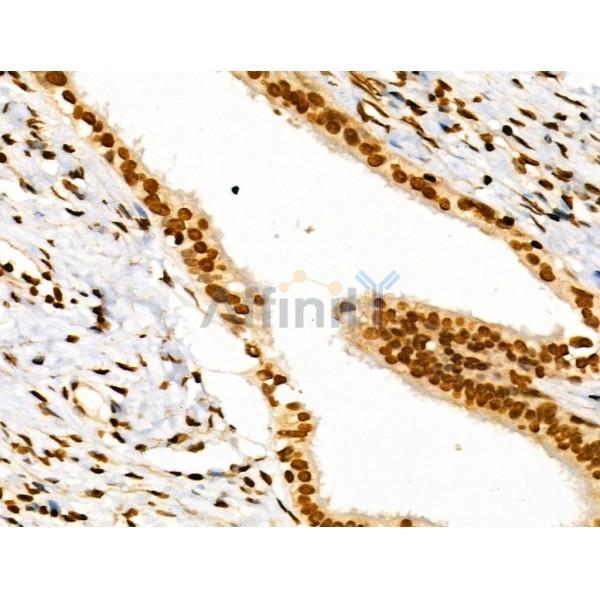 CDK8 Antibody - DF3186 at 1/100 staining Human ovarian cancer and adjacent normal tissues by IHC-P.