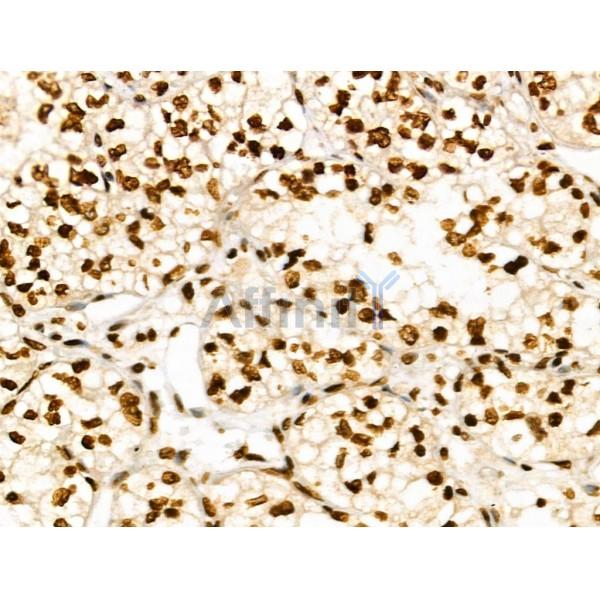 CDK8 Antibody - DF3186 at 1/100 staining Human kidney cancer by IHC-P.