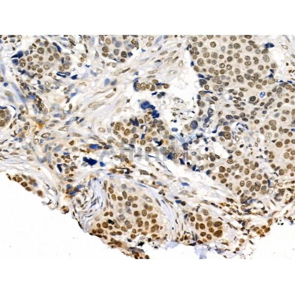 CDK8 Antibody - DF3186 at 1/100 staining Human mammary cancer by IHC-P.