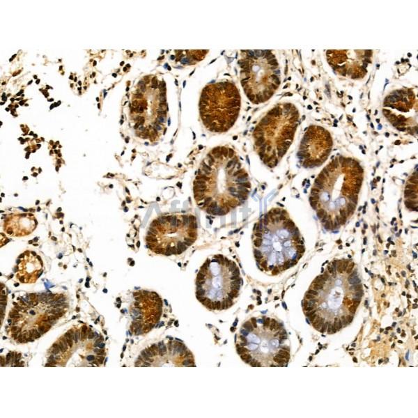 hnRNP F Antibody - DF3204 at 1/100 staining Human gastric cancer and adjacent normal tissues by IHC-P.