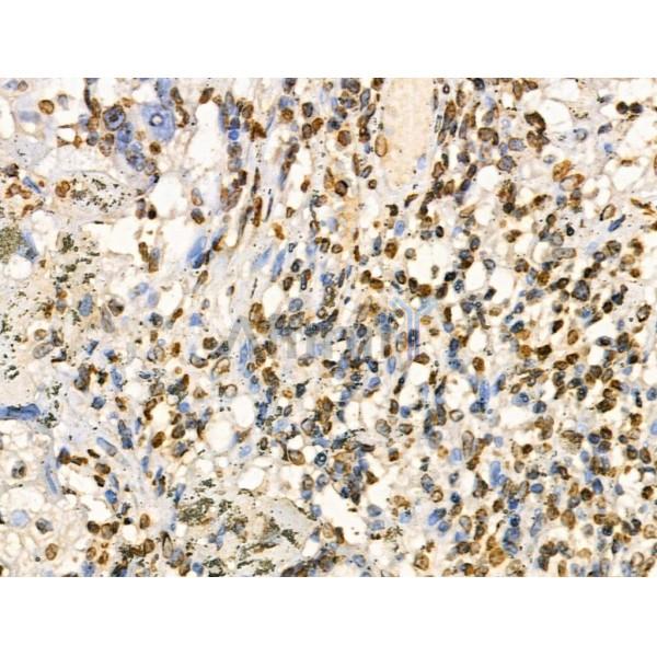 COPS2 Antibody - DF3222 at 1/100 staining Human ovarian cancer by IHC-P.