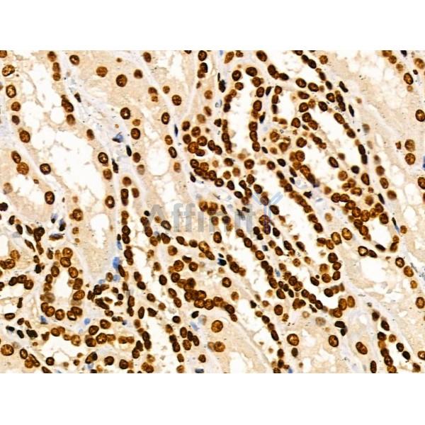 COPS2 Antibody - DF3222 at 1/100 staining Human kidney cancer and adjacent normal tissues by IHC-P.