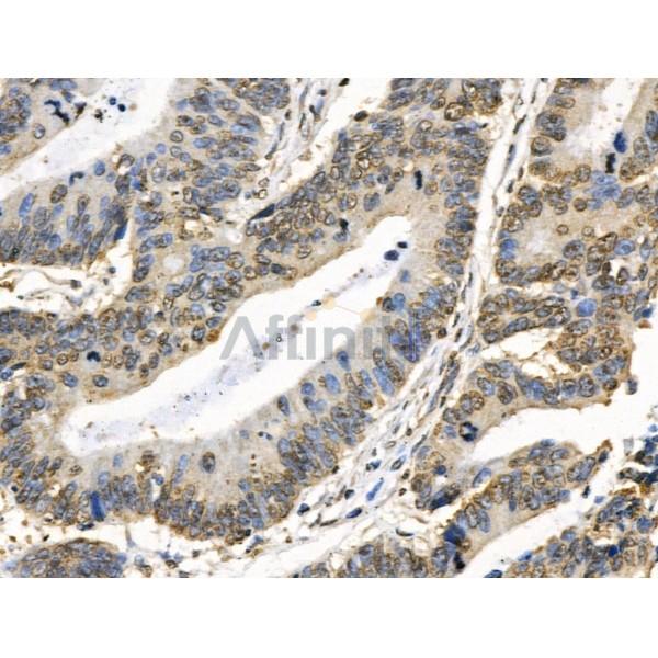 COPS2 Antibody - DF3222 at 1/100 staining Human colorectal cancer by IHC-P.