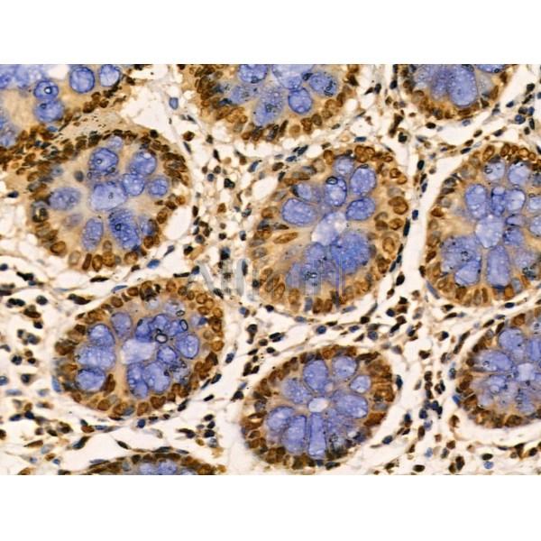PITX1 Antibody - DF3224 at 1/100 staining Human colorectal cancer and adjacent normal tissues by IHC-P.