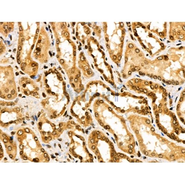 TRIP4 Antibody - DF3295 at 1/100 staining Human kidney cancer and adjacent normal tissues by IHC-P.