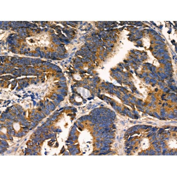 AKAP1 Antibody - DF3378 at 1/100 staining Human colorectal cancer by IHC-P.