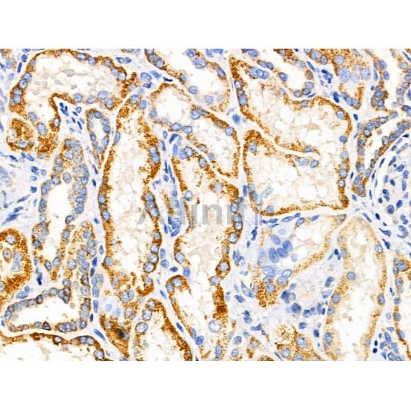 MRPL11 Antibody - DF3656 at 1/100 staining Human kidney cancer and adjacent normal tissues by IHC-P.