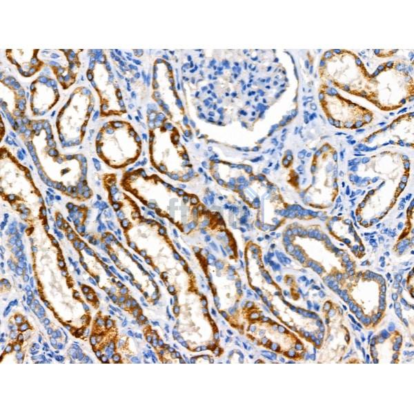 ACAT1 Antibody - DF3726 at 1/100 staining Human kidney cancer and adjacent normal tissues by IHC-P.