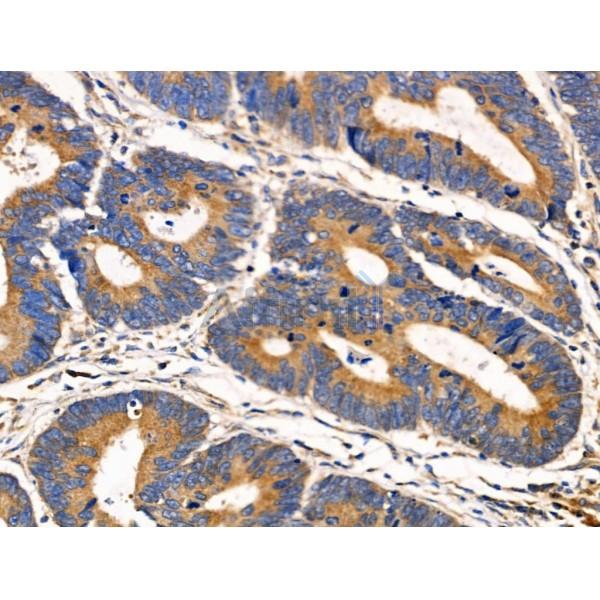 ACAT1 Antibody - DF3726 at 1/100 staining Human colorectal cancer by IHC-P.