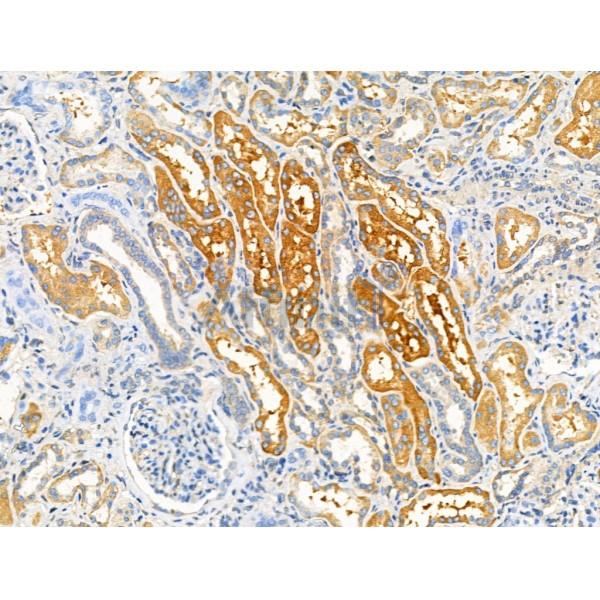 ADAMTS18 Antibody - DF3740 at 1/100 staining Human kidney cancer and adjacent normal tissues by IHC-P.