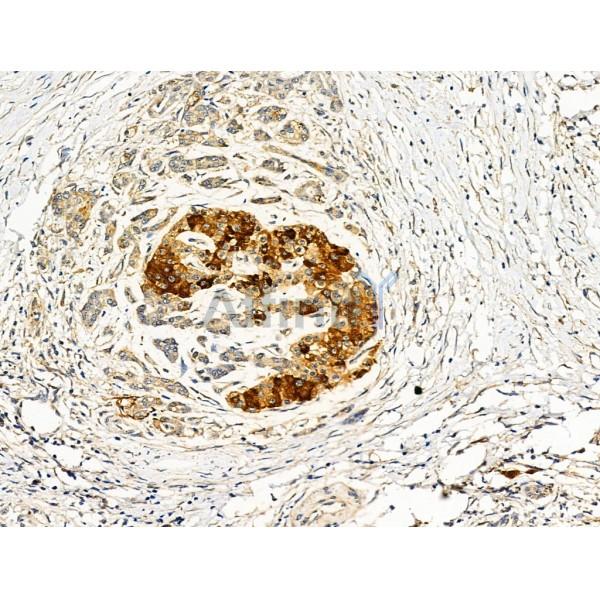 ADAMTS18 Antibody - DF3740 at 1/100 staining Human pancreatic cancer by IHC-P.