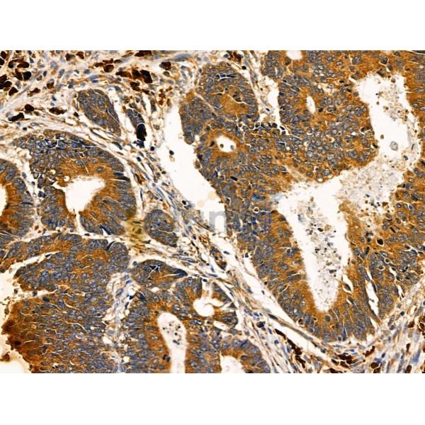 ADAMTS19 Antibody - DF3741 at 1/100 staining Human colorectal cancer by IHC-P.