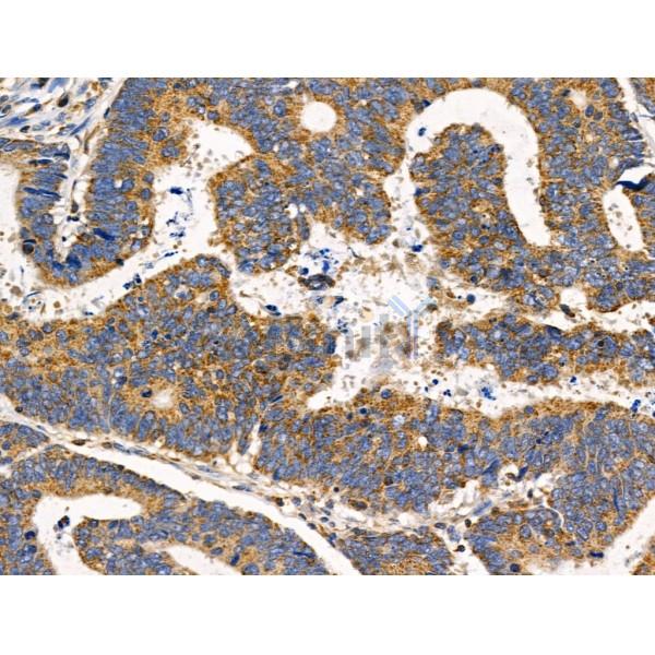 SGCA Antibody - DF3764 at 1/100 staining Human colorectal cancer by IHC-P.