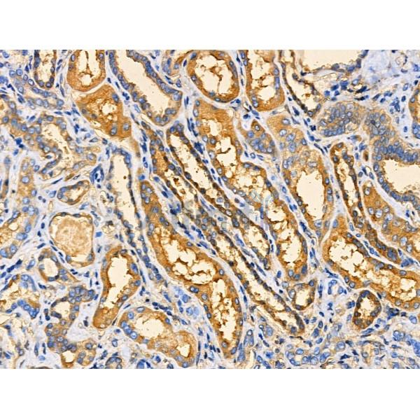 APBB2 Antibody - DF3769 at 1/100 staining Human kidney cancer and adjacent normal tissues by IHC-P.