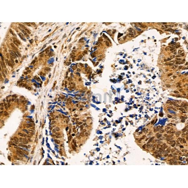 BRP16 Antibody - DF3851 at 1/100 staining Human colorectal cancer by IHC-P.