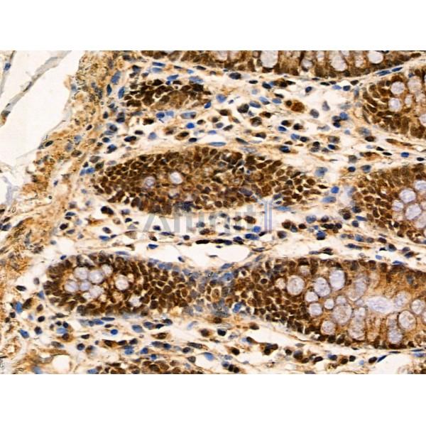 BRP16 Antibody - DF3851 at 1/100 staining Human colorectal cancer and adjacent normal tissues by IHC-P.