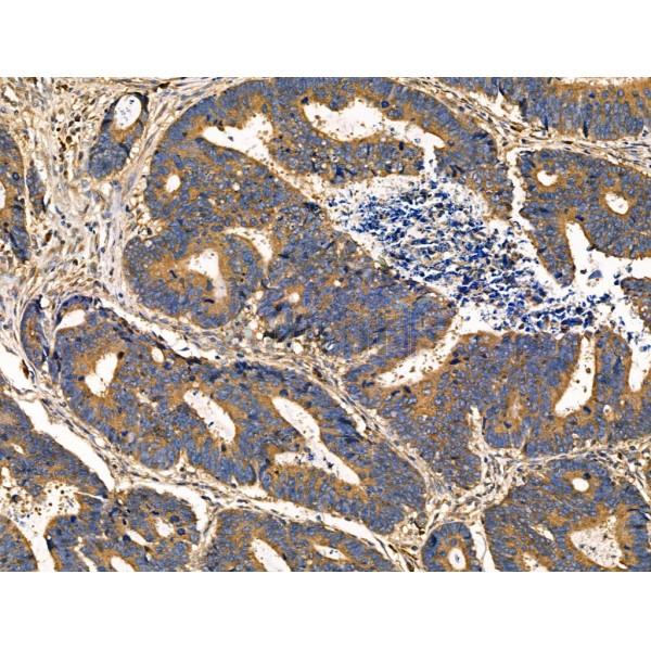 PNPLA8 Antibody - DF3865 at 1/100 staining Human colorectal cancer by IHC-P.