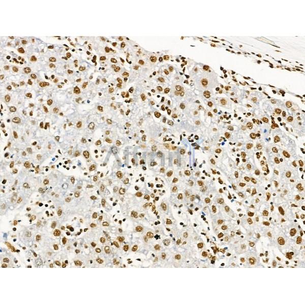 Acetyl-Histone H2A (Lys5) Antibody - AF4354 at 1/100 staining Human prostate cancer and adjacent normal tissues by IHC-P.
