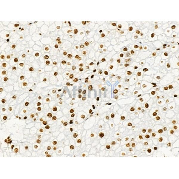 Acetyl-Histone H2A (Lys5) Antibody - AF4354 at 1/100 staining Human ovarian cancer and adjacent normal tissues by IHC-P.