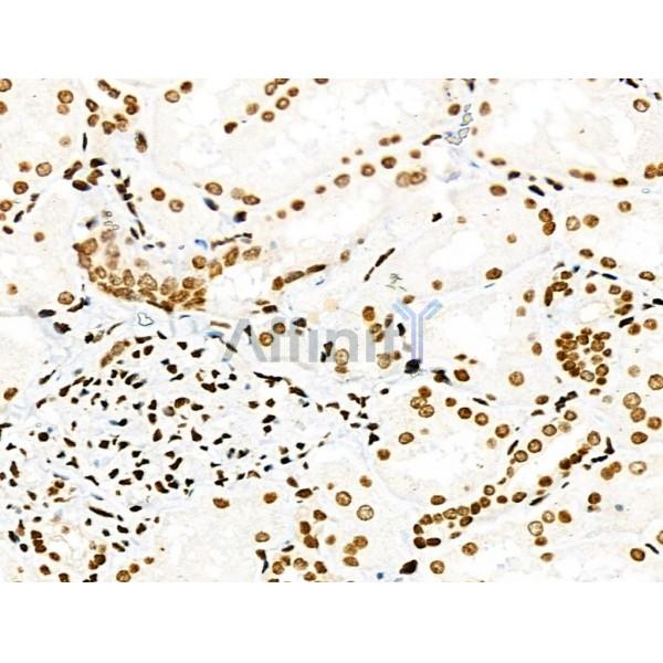 Phospho-PDX1 (Ser66) Antibody - AF8301 at 1/100 staining Human kidney cancer and adjacent normal tissues by IHC-P.