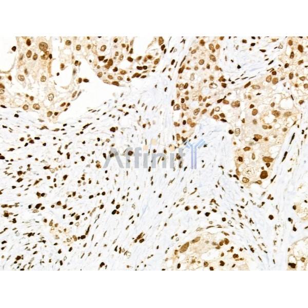 Phospho-PDX1 (Ser66) Antibody - AF8301 at 1/100 staining Human ovarian cancer by IHC-P.