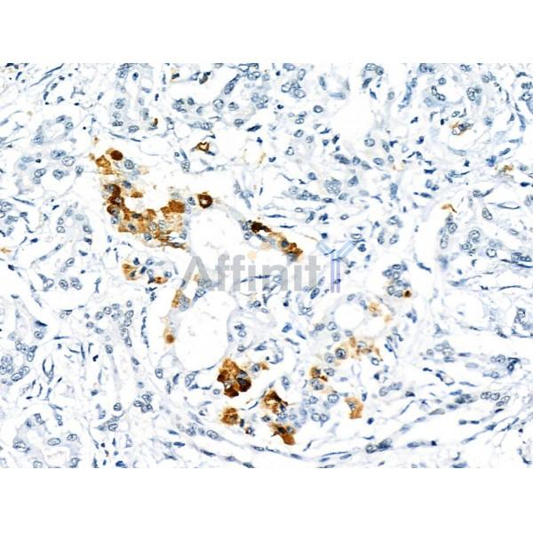 Phospho-PDX1 (Ser66) Antibody - AF8301 at 1/100 staining Human pancreatic cancer and adjacent nomal tissues by IHC-P.