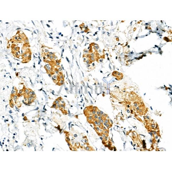 Phospho-PDX1 (Ser66) Antibody - AF8301 at 1/100 staining Human pancreatic cancer by IHC-P.