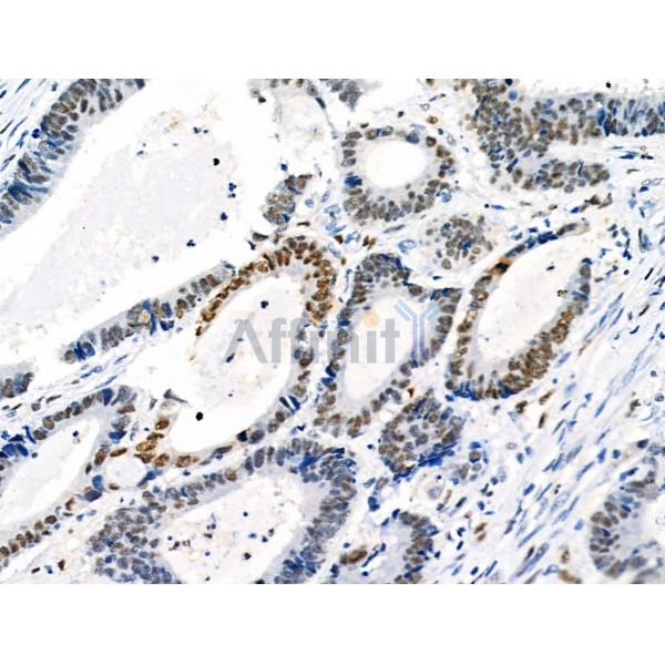 Phospho-PPAR  alpha (Ser12) Antibody - AF8392 at 1/100 staining Human colorectal cancer by IHC-P.