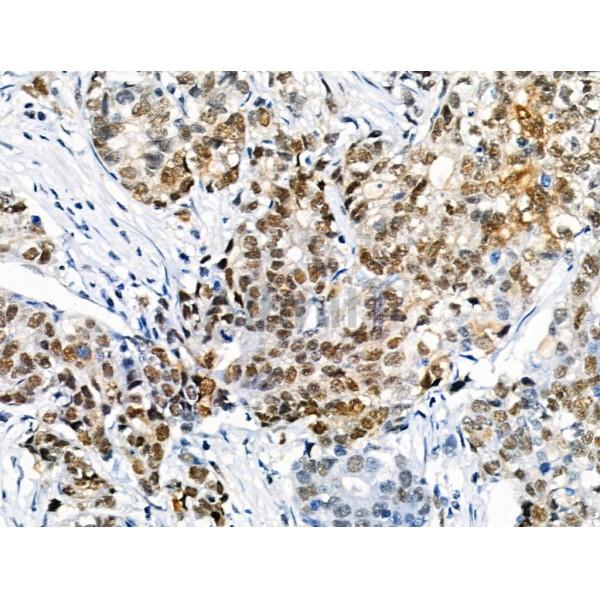 Phospho-PPAR  alpha (Ser12) Antibody - AF8392 at 1/100 staining Human gastric cancer by IHC-P.