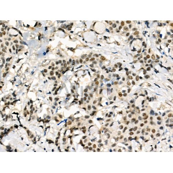 Phospho-PPAR  alpha (Ser12) Antibody - AF8392 at 1/100 staining Human mammary cancer by IHC-P.