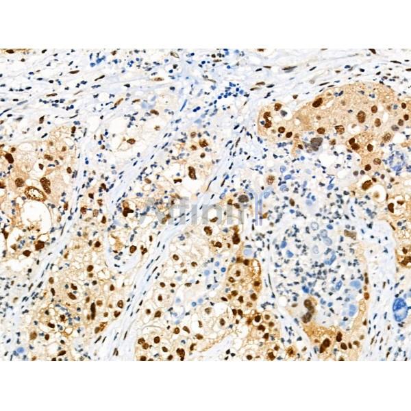 Phospho-PPAR  alpha (Ser12) Antibody - AF8392 at 1/100 staining Human ovarian cancer by IHC-P.