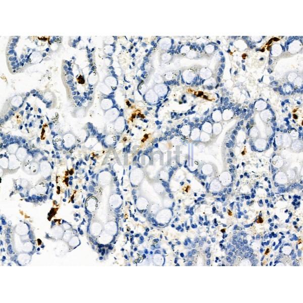 Phospho-R-Ras (Tyr66) Antibody - AF8509 at 1/100 staining Human gastric cancer and adjacent normal tissues by IHC-P.